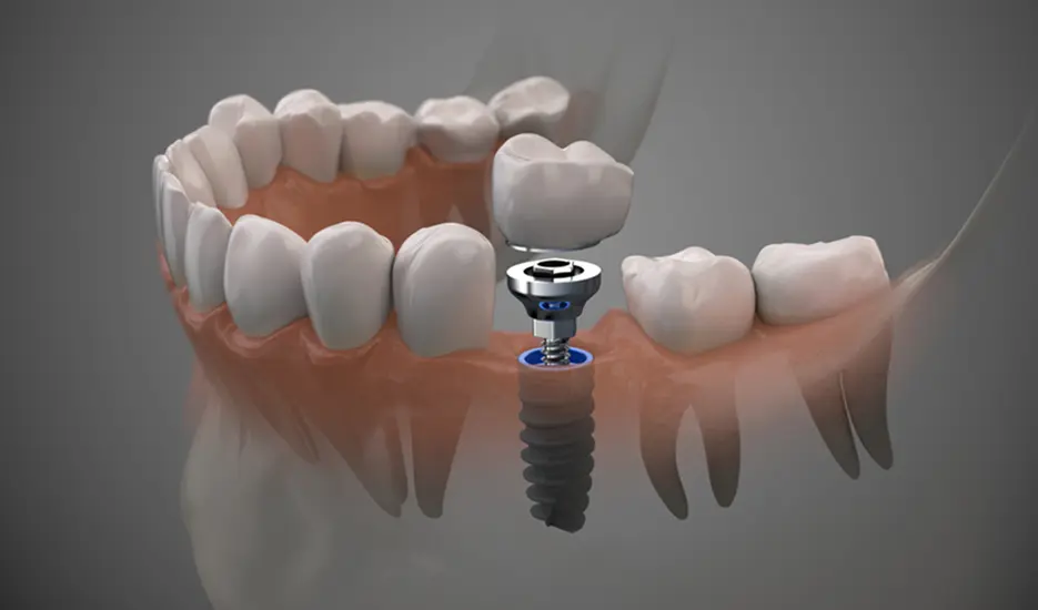 Modesto Single Dental Implants
