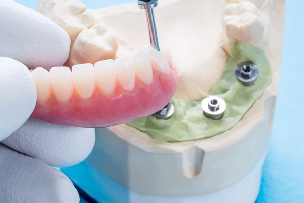Will I Need A Bone Graft For The All On   Procedure?