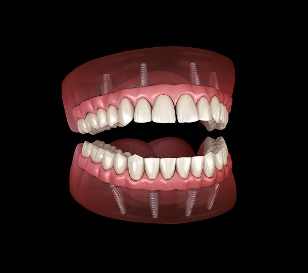 Modesto Reduce Sports Injuries With Mouth Guards