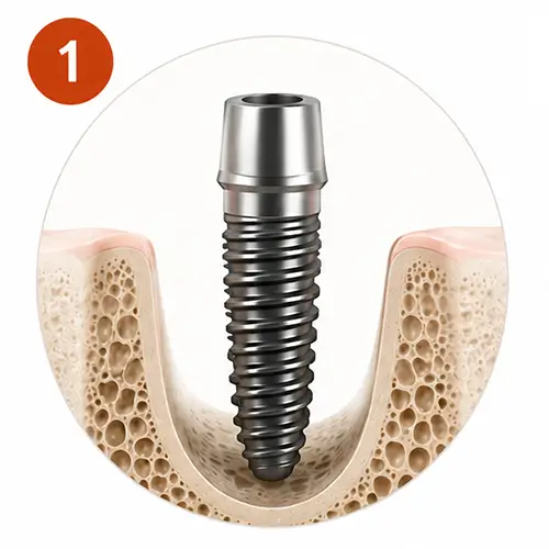 Implant Placement